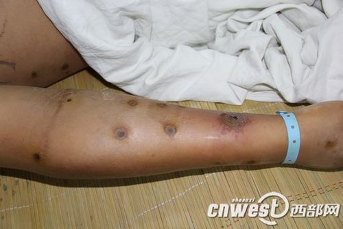 数百人被毒蜂被蜇伤