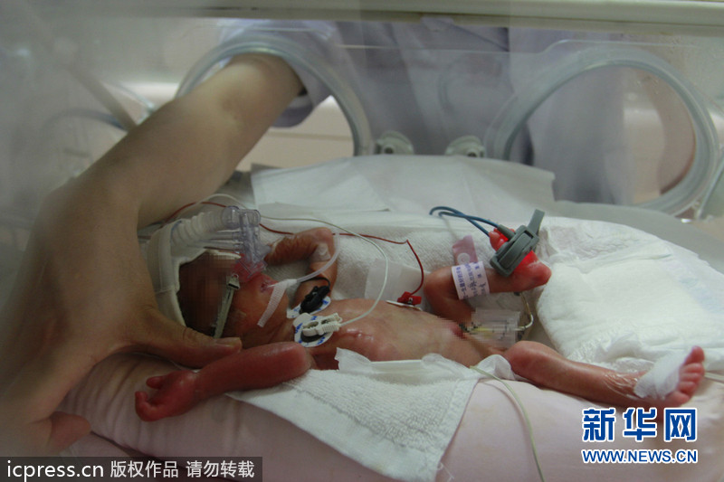 湖南新生罕见袖珍女婴