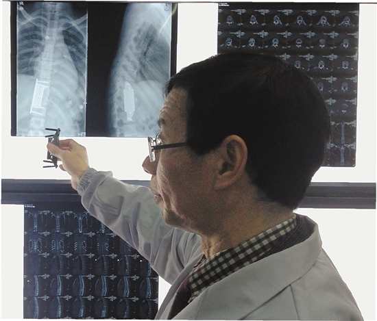 大一院完成国内首例新技术 3D打印重铸胸椎-浙