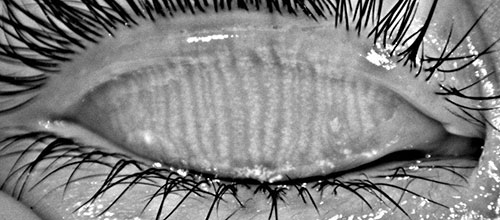 每天看电脑超3小时 九成人患干眼症 滴眼液别随意乱用