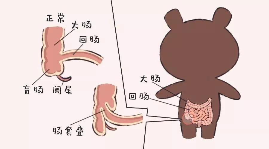 宝宝肚痛呕吐别忽视小心是肠套叠