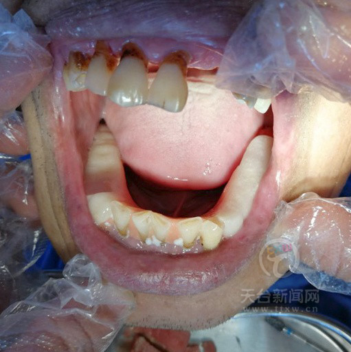 "做到必要的保牙,能保存的牙齿要尽量保住,保存牙体组织以及牙齿,尽