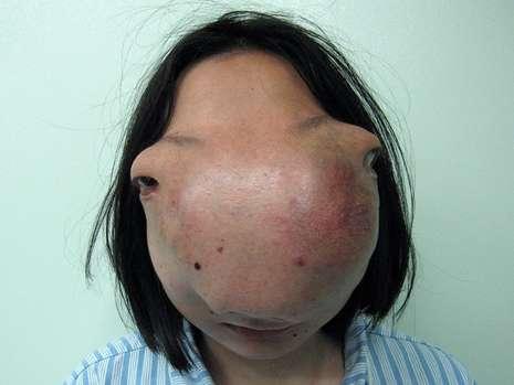 浙江女孩面部长出巨大肿瘤