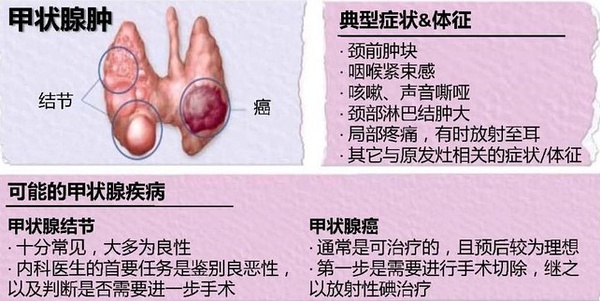 碘对甲状腺的影响尚未明确同样,甲状腺结节简单的也可分为二类,良性