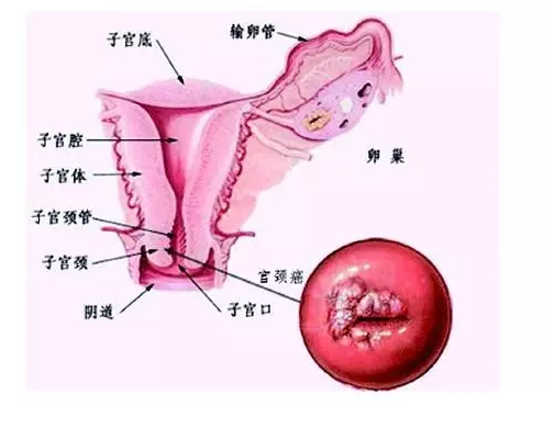 初期宫颈癌图片图片